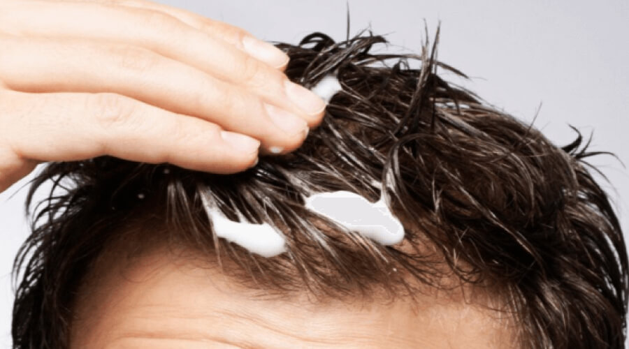 What is Minoxidil & How Does it Work?